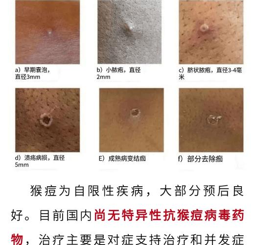 猴痘疫情(猴痘疫情最新进展)-第6张图片 猴痘疫情(猴痘疫情最新进展)-第6张图片