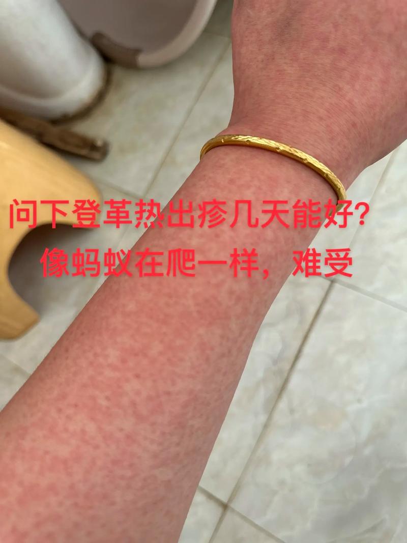 广东登革热疫情/广东登革热疫情怎么样传染的-第4张图片 广东登革热疫情/广东登革热疫情怎么样传染的-第4张图片