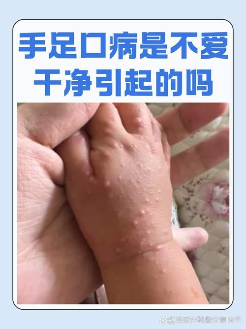 【水痘聚集性疫情定义,水痘是密集的吗】-第3张图片 【水痘聚集性疫情定义,水痘是密集的吗】-第3张图片