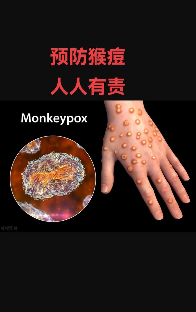 猴痘疫情(猴痘疫情国家名单)-第4张图片 猴痘疫情(猴痘疫情国家名单)-第4张图片