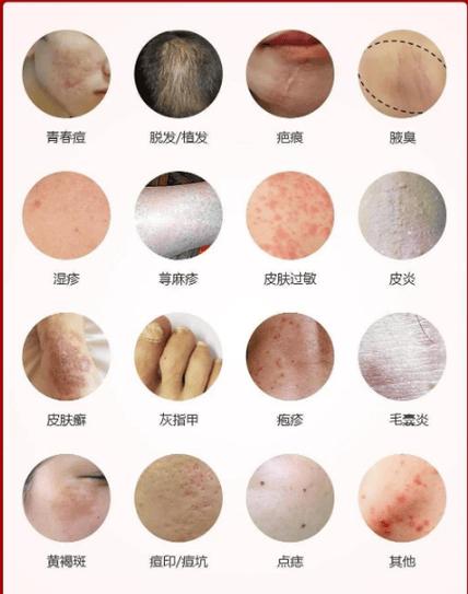 水痘聚集性疫情定义-水痘聚集性疫情基本标准是多少例-第4张图片
