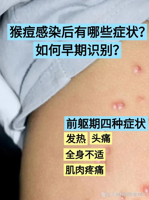 猴痘疫情最新消息-猴痘疫情最新消息2025年-第3张图片