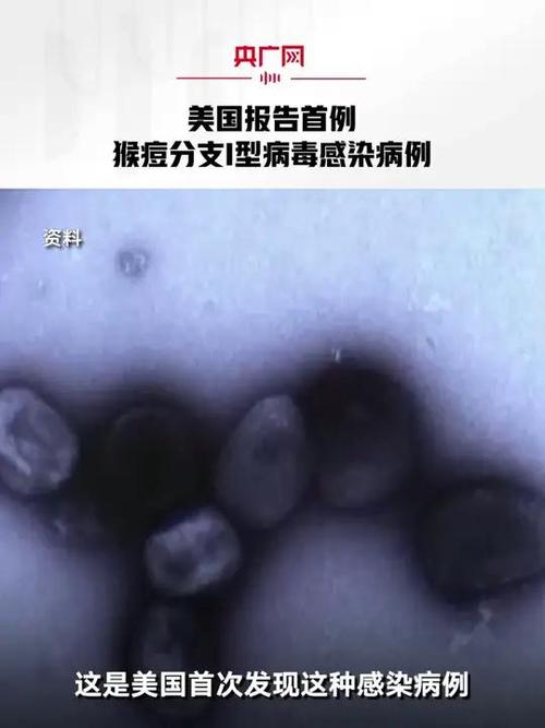 猴痘疫情最新消息-猴痘疫情最新消息2025年-第6张图片