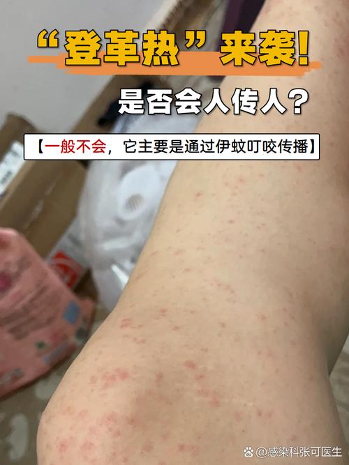 登革热疫情-登革热疫情防控-第3张图片